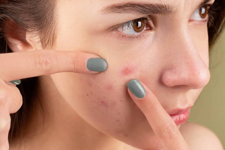remedios caseros para el acné