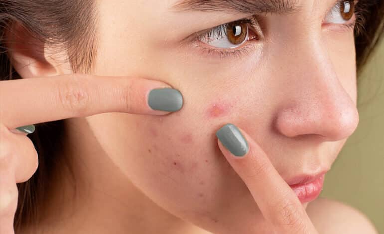 Easy And Effective Home Remedies For Acne – Home Acne Treatments To Try