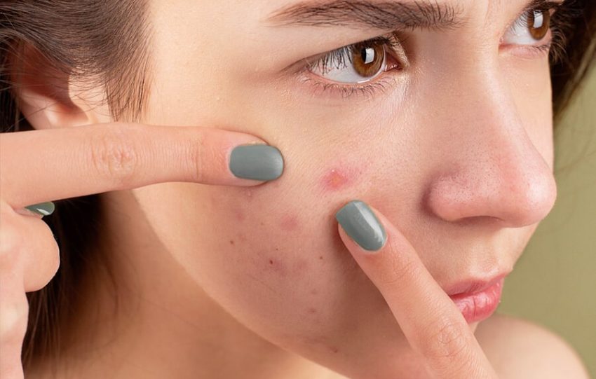 home remedies for acne